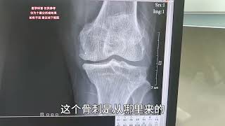 膝关节骨性关节炎，详细病情分析讲解，听听肖医生如何讲解(2)