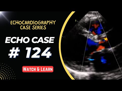 Echocardiography Case 124 Echo Spot Diagnosis Case Series Heart Youtube