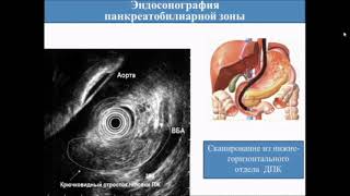 Эндосонография верхних отделов ЖКТ