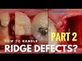 How to handle ridge defects? PART 2