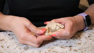What To Do If Your Palate Expander appliance Comes Loose | Belmar Orthodontics