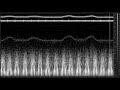 heart sound lab 58 02 1955 . pure pulmonary stenosis diastolic