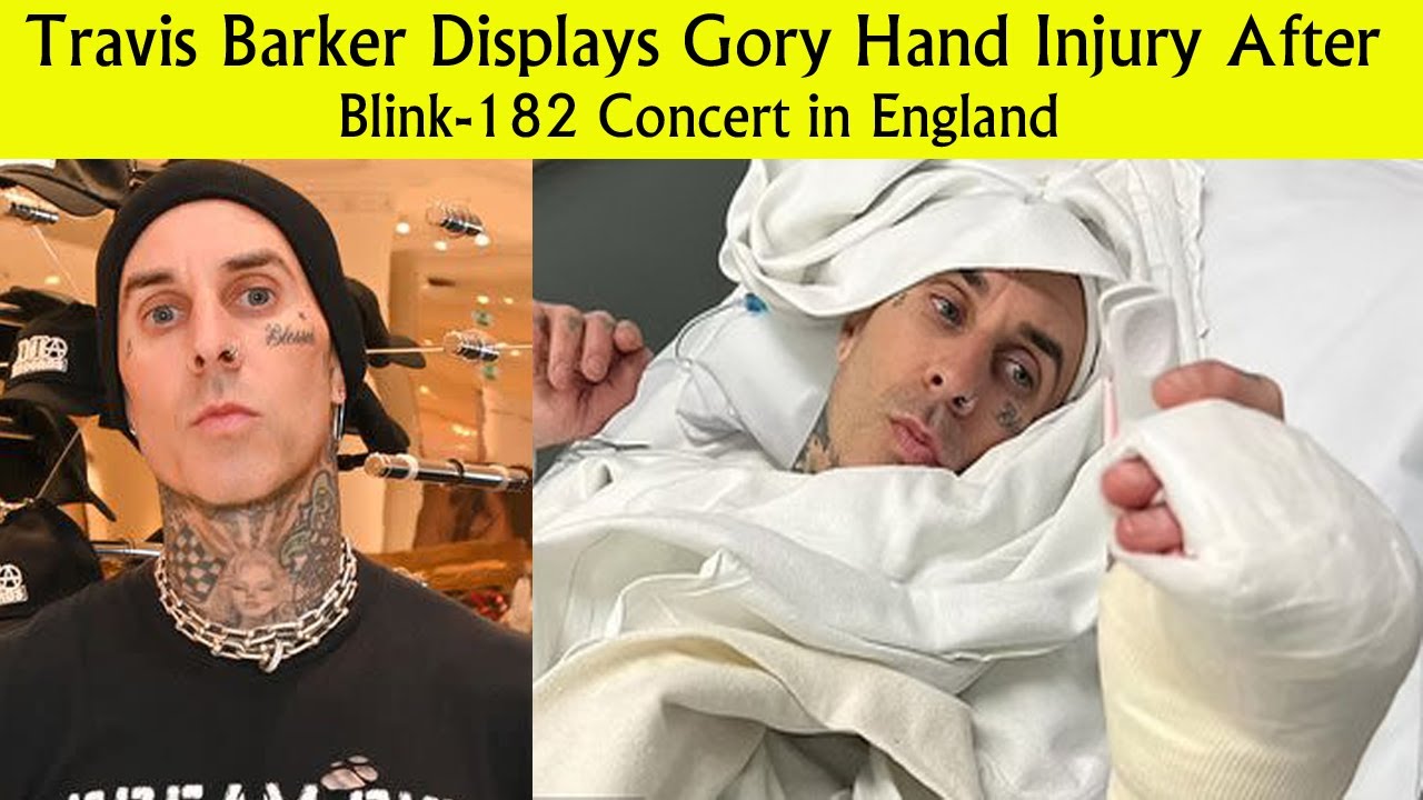 Travis Barker Displays Gory Hand Injury After Blink-182 Concert In ...