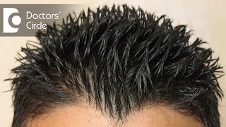How to treat Androgenic Alopecia not responding to minoxidil & finasteride? - Dr