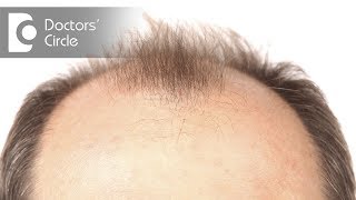Treatment for male pattern baldness in Ayurveda - Dr. Farida Khan