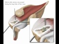 rotator cuff repair l shaped tear shoulderdoc.mov