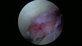 L medial menisectomy 4 14 22 ME