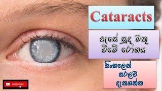 Cataracts/ඇසේ සුද මතුවීමේ රෝගය/ how it happens/ causes/symptoms/ treatment/ sinhala/ how to prevent