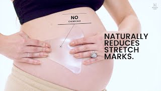 The Only Way to Naturally Treat Stretch Marks