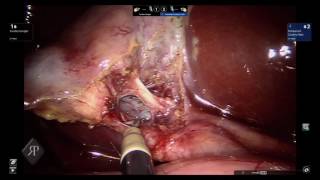 DaVinci Single Incision Cholecystectomy