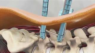 Palisade™ Pedicular Fixation System Animation