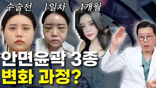 [JP]윤곽3종 수술 1일차, 7일차, 30일차 후기