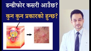 [English subtitles] डन्डीफोर कसरी आउँछ? कुन कुन प्रकारको हुन्छ? | Causes and type of acne