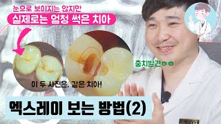 치과엑스레이에서 충치 찾는 방법! 눈에 보이지 않는 충치, 실제로 찍어서 열어보면?