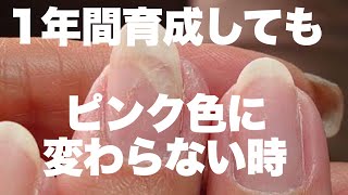 視聴者様からの相談（３）剥離した爪が1年間くっつかない場合