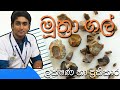 මූත්‍රා ගල් ඇතිවීම |ලක්ශණ | ප්‍රතිකාර |Kidney stones | treatment in Sinhala