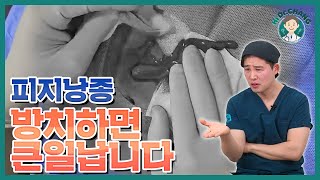 피지낭종! 방치하면 큰일납니다! (실제 사례)