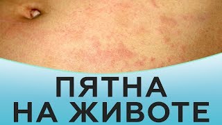 Пятна на животе | Клиника Частная Практика