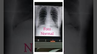 CARA MEMBEDAKAN ABNORMAL DAN NORMAL FOTO THORAX RONTGEN