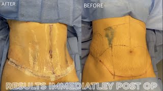 High Definition Abdominoplasty (Muscle Plication) by Dr. Ravi