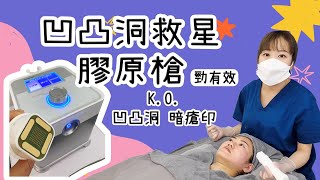 凹凸洞救星- 膠原槍 ｜KO 凹凸洞 ｜暗瘡印｜勁有效｜￼￼做一次有效果｜凹凸洞聖手｜性價比超高｜唔Hard Sales｜良心￼小店｜火山洞有救了｜做完自信返曬來｜男女都做得｜