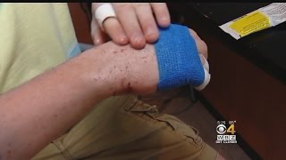 Bi-Weekly Shot Shows Promise To Treat Severe Eczema