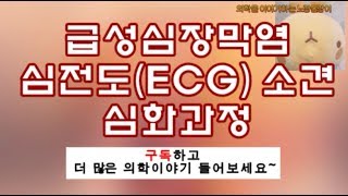 급성심장막염(심막염, acute pericarditis) 심전도(ECG) 특징 [심화]