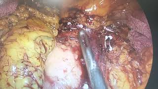 Laparoscopic right Hemicolectomy with CME CVL - FINAL VIEW