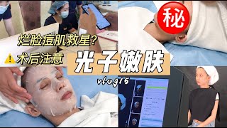 《黎拉的坏品味》VLOG | 光子嫩肤深度体验