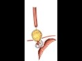 Animation Two Big Boluses - Gastric Banding System