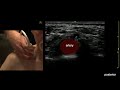 supraclavicular brachial plexus identification for pocus guided regional anesthesia