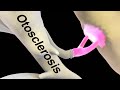 Hearing Loss Due to Otosclerosis