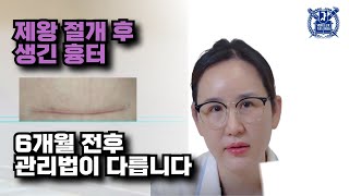 제왕절개 보톡스 흉터, 초기에 집에서 쉽게 관리하는 방법