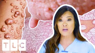 Dr. Lee's MOST Interesting Cases: Mysterious Rashes, Cysts & More! | Dr Pimple Popper