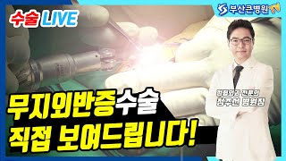 직접 보여드립니다. 무지외반증 수술 LIVE_부산큰병원 정주선 병원장