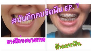 บันทึกคนจัดฟัน EP.7 : ยางจัดฟันสีม่วงพลาสเทล ฟันบิดตัวมาแล้ว