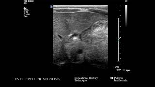 [US] Ultrasound for Pyloric Stenosis | Search Pattern