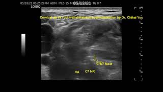 C7 nerve root hydrodissection transforaminal way better than at transverse process 頸椎神經根解套注射 尤稚凱醫師