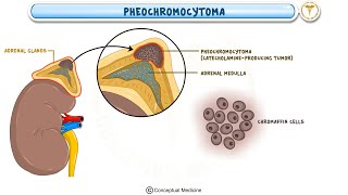 Pheochromocytoma Animation : Etiology, Clinical features, Diagnosis and Treatment