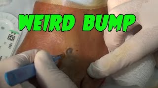 Lumpy Foot Bump Removal