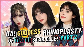 My Plastic Surgery Vlog in Korea part 2 Elle's Rhinoplasty and Fat grafting at DA (Before and After)