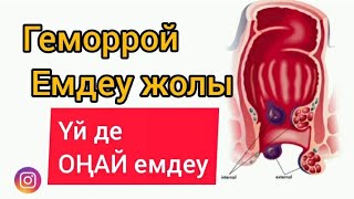 Геморрой үй жағдайында қалай емдейміз? Геморройды емдеудің оңай жолы.