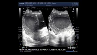 Secondary Hematometra due to atresia of the cervix and vagina following the inflammation.