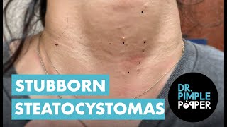 Stubborn Steatocystomas! Dr Pimple Popper PATIENTLY Work On Sweet Woman's Neck