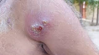 Carbuncle on Shoulder | Skin Infection