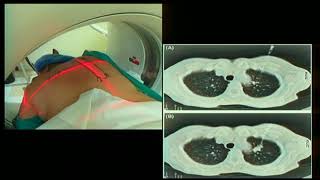 42  Cirugía Radioguiada en Nódulo Pulmonar - Dr. Oscar Méndez