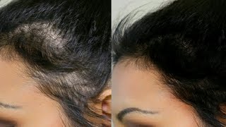 LEECH OIL FOR HAIR REGROWTH | Nature Sure Jonk Tail