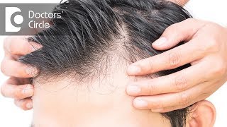 Who is best to consult for Androgenic Alopecia? - Dr. Aruna Prasad