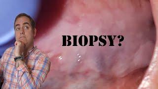 Oral Biopsies: What to Expect