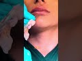 Lip filler treatment - Dr Guncel Ozturk